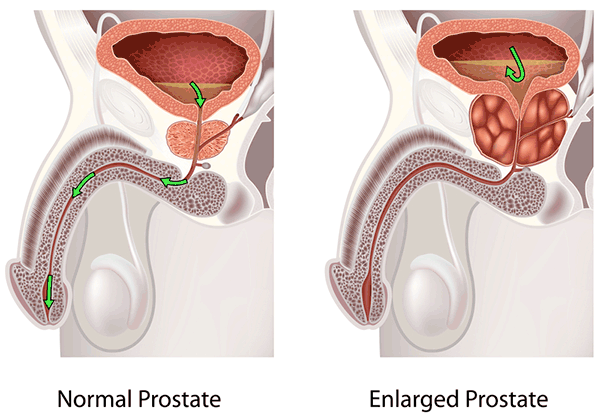Enlarged Prostate means the same as Benign Prostatic Hyperplasia.