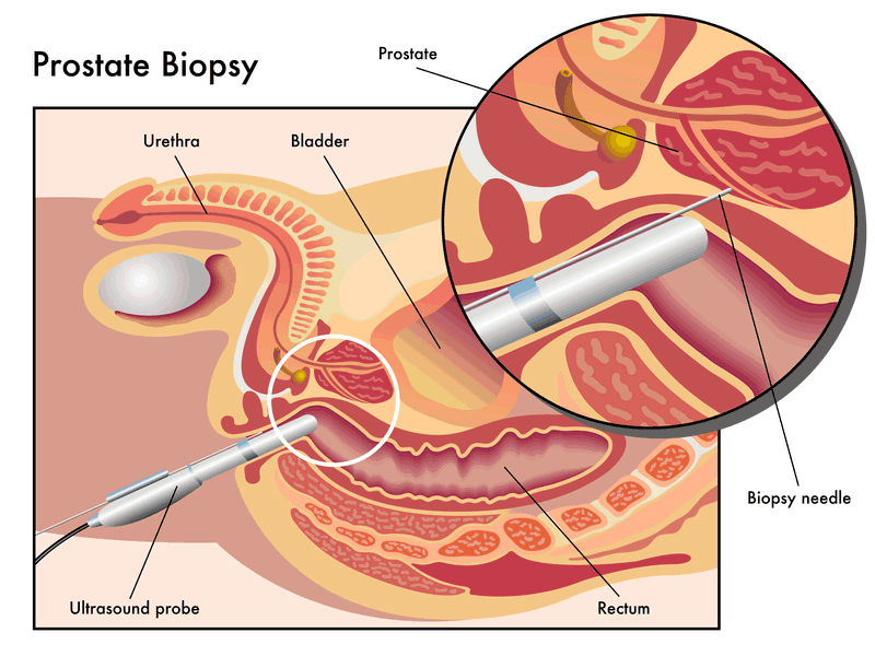 Prostate Health Biopsy