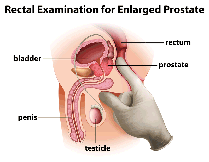 Prostate Exam